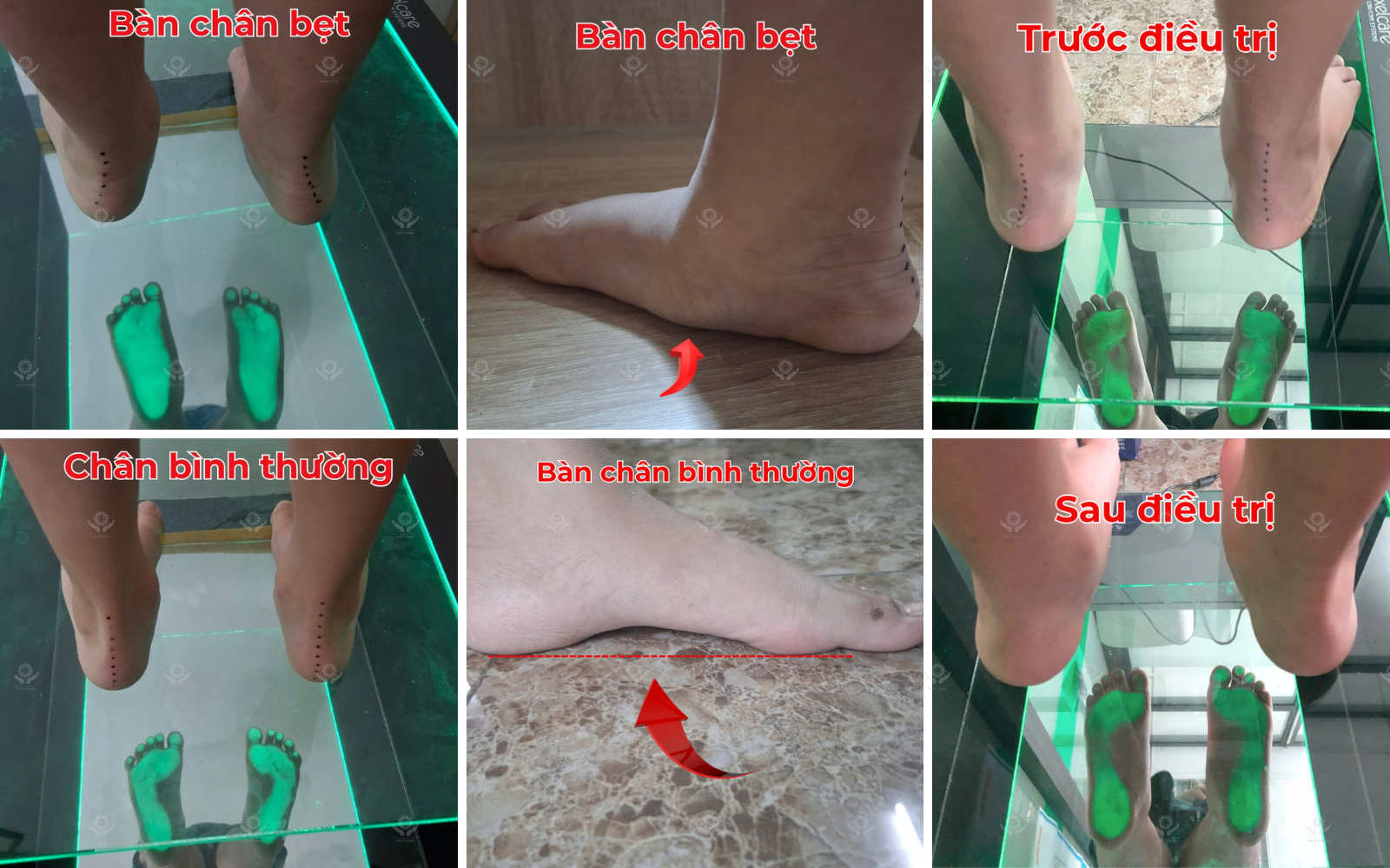 Bàn chân bẹt ở trẻ em Dấu hiệu, nguyên nhân và phương pháp điều trị  (5).png