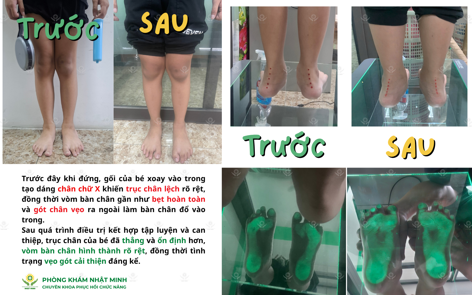 Bàn chân bẹt ở trẻ em Dấu hiệu, nguyên nhân và phương pháp điều trị  (6).png