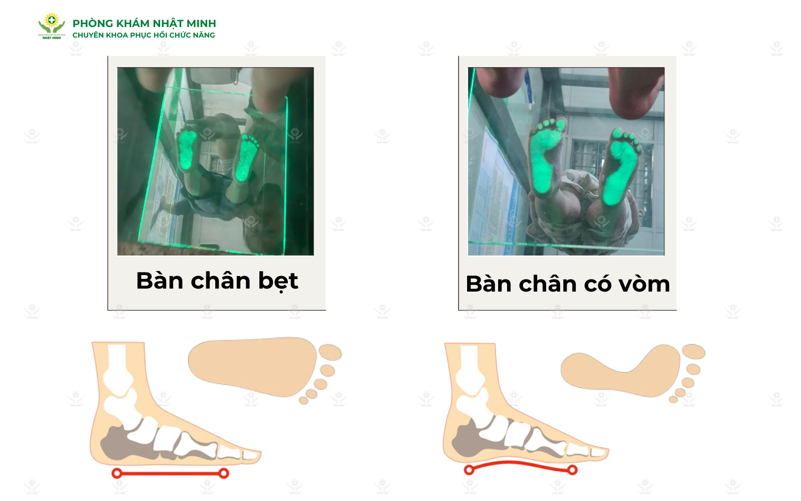 Lộ trình 4 bước cách chữa bàn chân bẹt không phẫu thuật